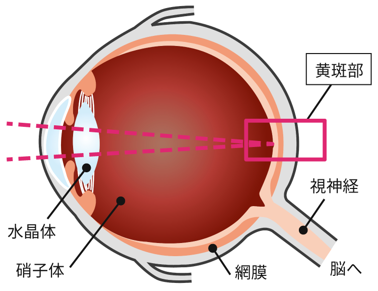 加齢黄斑変性とは